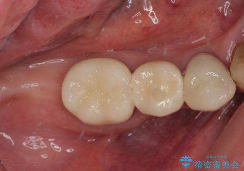 破折してしまった奥歯 抜歯即時埋入で短期間インプラント治療の症例 治療後
