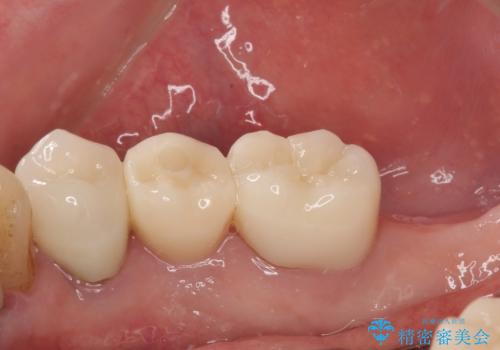 破折してしまった奥歯 抜歯即時埋入で短期間インプラント治療の治療後