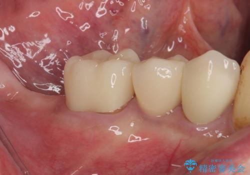 破折してしまった奥歯　抜歯即時埋入で短期間インプラント治療の治療後