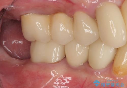 破折してしまった奥歯　抜歯即時埋入で短期間インプラント治療の治療後