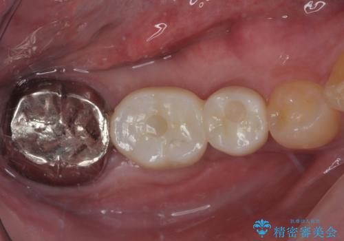 放置して膿で腫れ上がった奥歯　短期間でのインプラント治療の治療後