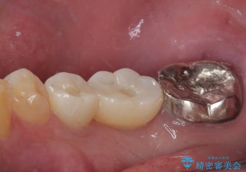 放置して膿で腫れ上がった奥歯 短期間でのインプラント治療の治療後