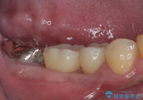 放置して膿で腫れ上がった奥歯　短期間でのインプラント治療の治療後