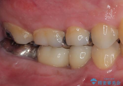 放置して膿で腫れ上がった奥歯 短期間でのインプラント治療の治療後