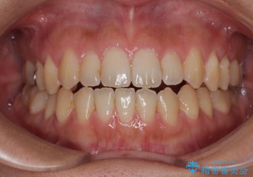 【モニター】食事が取りづらい 極端な開咬をインビザラインで解決の症例 治療後