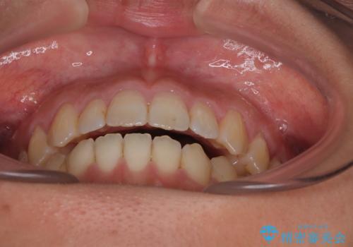 【モニター】食事が取りづらい 極端な開咬をインビザラインで解決の治療後