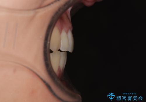 【モニター】食事が取りづらい　極端な開咬をインビザラインで解決の治療後