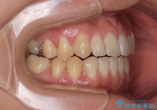 【モニター】食事が取りづらい 極端な開咬をインビザラインで解決の治療後