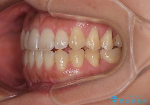 【モニター】食事が取りづらい 極端な開咬をインビザラインで解決の治療後