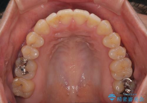 【モニター】食事が取りづらい　極端な開咬をインビザラインで解決の治療後