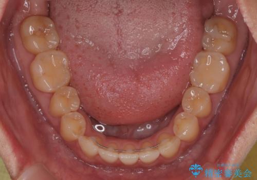 【モニター】食事が取りづらい 極端な開咬をインビザラインで解決の治療後