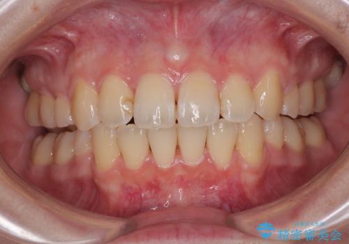 デコボコだらけの歯列をきれいに　ワイヤー装置での抜歯矯正治療の症例 治療後