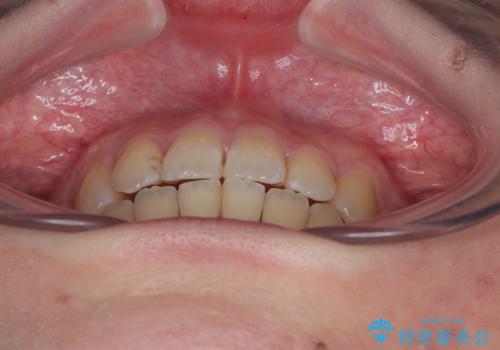 デコボコだらけの歯列をきれいに ワイヤー装置での抜歯矯正治療の治療後