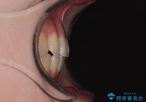 デコボコだらけの歯列をきれいに　ワイヤー装置での抜歯矯正治療の治療後