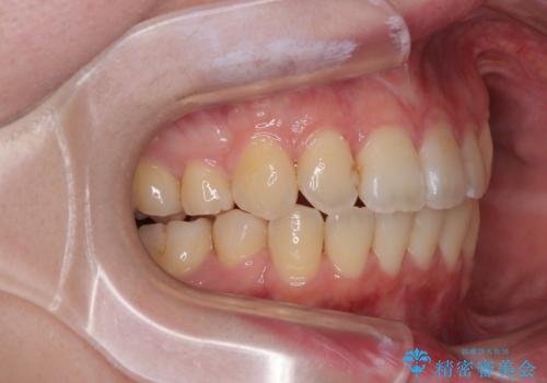 デコボコだらけの歯列をきれいに ワイヤー装置での抜歯矯正治療の治療後