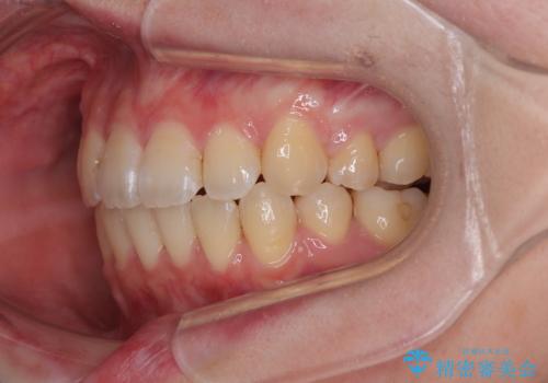 デコボコだらけの歯列をきれいに　ワイヤー装置での抜歯矯正治療の治療後