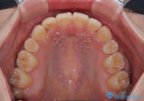 デコボコだらけの歯列をきれいに ワイヤー装置での抜歯矯正治療の治療後