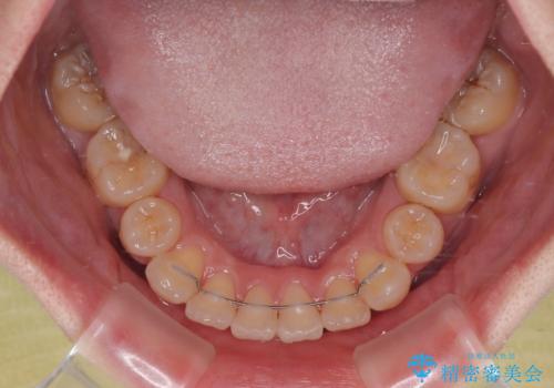 デコボコだらけの歯列をきれいに ワイヤー装置での抜歯矯正治療の治療後