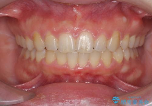 深い噛み合わせ、すきっ歯の改善　ワイヤーを用いたマルチブラケット矯正の治療後