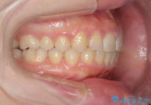 深い噛み合わせ、すきっ歯の改善 ワイヤーを用いたマルチブラケット矯正の治療後