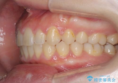 深い噛み合わせ、すきっ歯の改善 ワイヤーを用いたマルチブラケット矯正の治療後