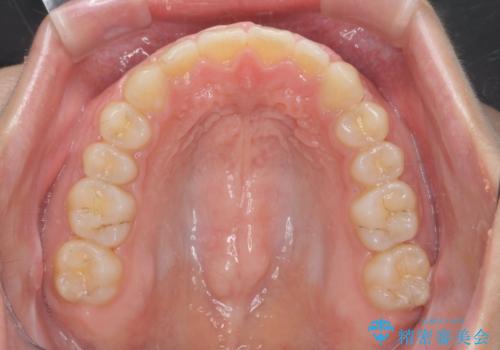 深い噛み合わせ、すきっ歯の改善 ワイヤーを用いたマルチブラケット矯正の治療後