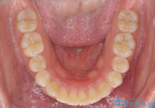 深い噛み合わせ、すきっ歯の改善　ワイヤーを用いたマルチブラケット矯正の治療後