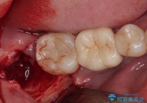 右下の親知らずを抜きたい　親知らず抜歯の治療中