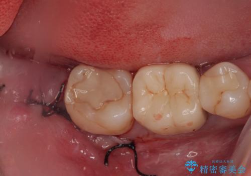 右下の親知らずを抜きたい　親知らず抜歯の症例 治療後
