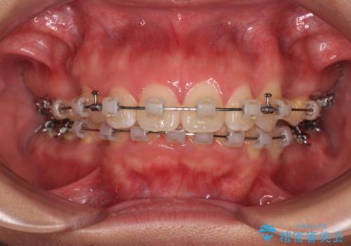 唇が閉じられない　ワイヤー装置による抜歯矯正治療の治療中
