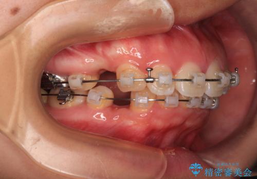 唇が閉じられない　ワイヤー装置による抜歯矯正治療の治療中