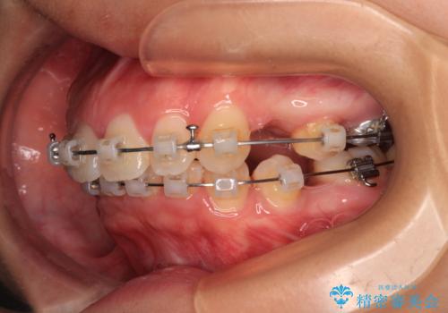唇が閉じられない ワイヤー装置による抜歯矯正治療の治療中