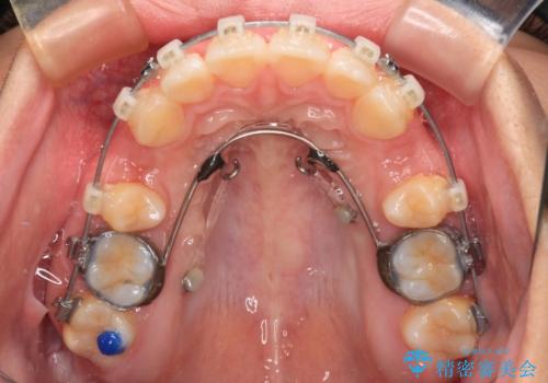 唇が閉じられない　ワイヤー装置による抜歯矯正治療の治療中