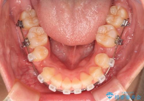 唇が閉じられない ワイヤー装置による抜歯矯正治療の治療中