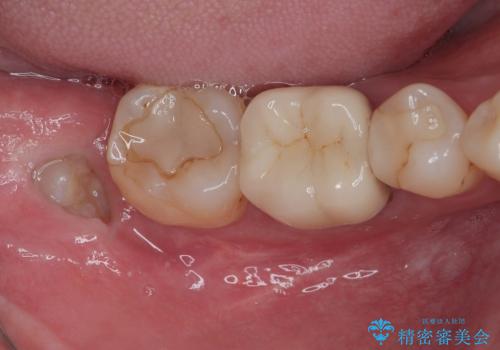 右下の親知らずを抜きたい 親知らず抜歯の症例 治療前