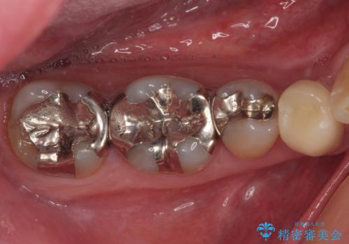 金属の詰め物が取れた　オールセラミッククラウン