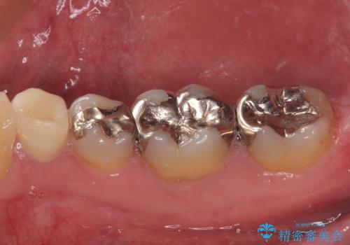 金属の詰め物が取れた オールセラミッククラウンの治療後