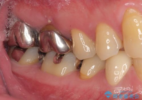 金属の詰め物が取れた　オールセラミッククラウンの治療後