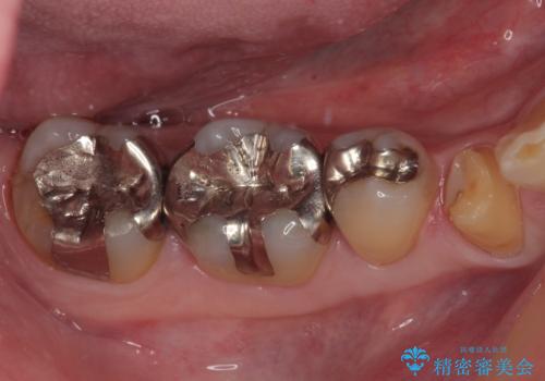 金属の詰め物が取れた オールセラミッククラウンの治療中