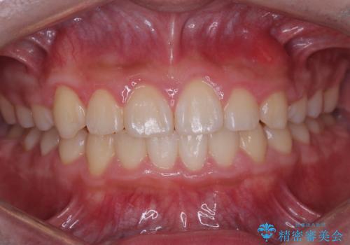 八重歯・歯並びのデコボコとディープバイトを改善した抜歯ワイヤー矯正症例の治療後