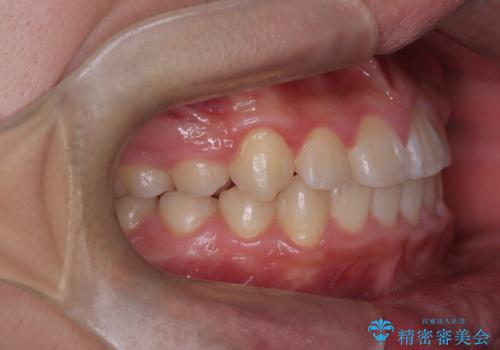 八重歯・歯並びのデコボコとディープバイトを改善した抜歯ワイヤー矯正症例の治療後