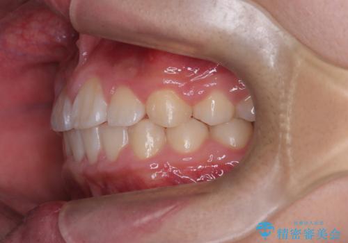 八重歯・歯並びのデコボコとディープバイトを改善した抜歯ワイヤー矯正症例の治療後