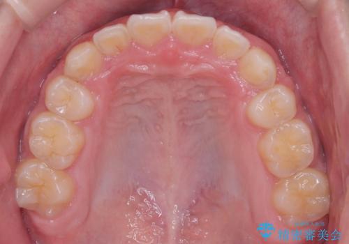 八重歯・歯並びのデコボコとディープバイトを改善した抜歯ワイヤー矯正症例の治療後
