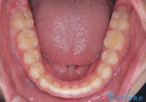 八重歯・歯並びのデコボコとディープバイトを改善した抜歯ワイヤー矯正症例の治療後