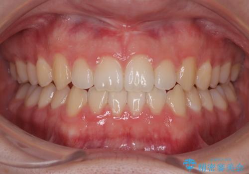 すきっ歯は放置NG?インビザラインで目立たず改善の治療中