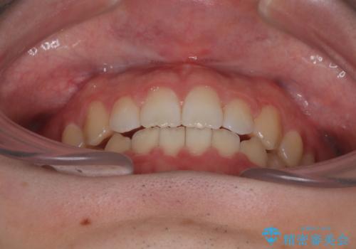 すきっ歯は放置NG?インビザラインで目立たず改善の治療中