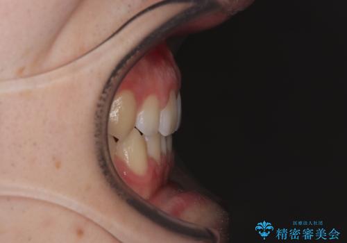 すきっ歯は放置NG?インビザラインで目立たず改善の治療中