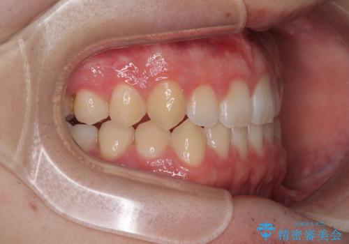 すきっ歯は放置NG?インビザラインで目立たず改善の治療中