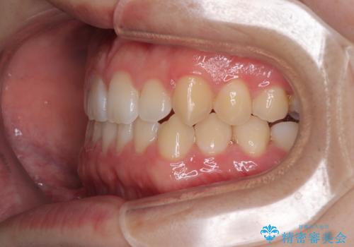 すきっ歯は放置NG?インビザラインで目立たず改善の治療中