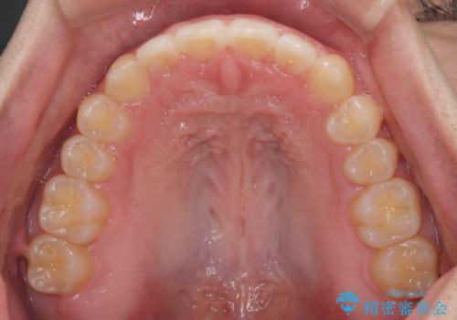 すきっ歯は放置NG?インビザラインで目立たず改善の治療中